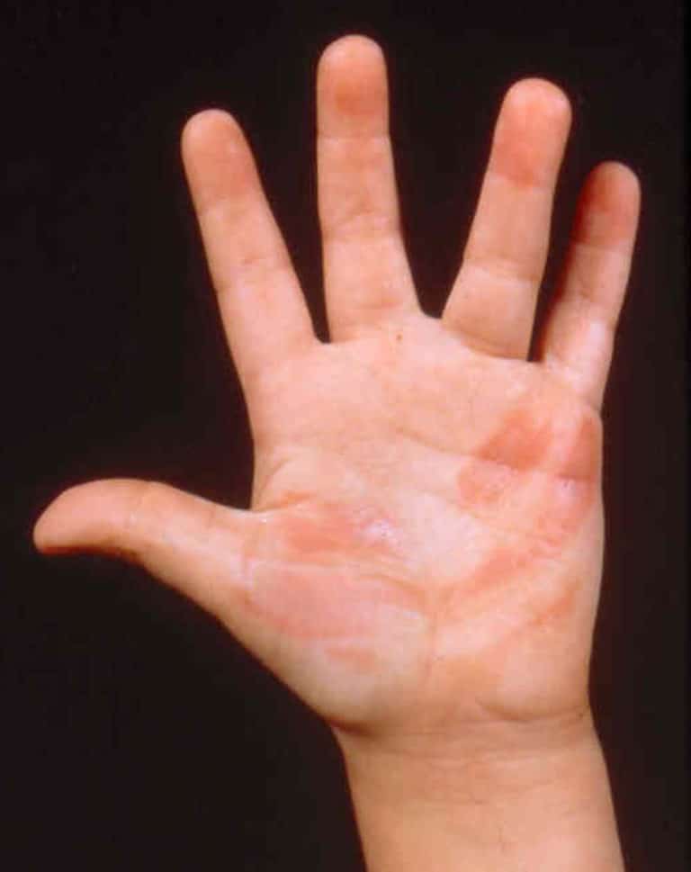 burn victims hands